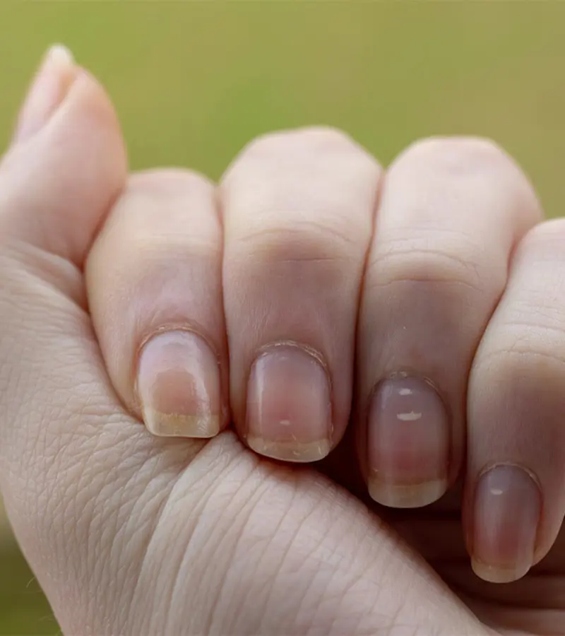 White Spots on Nails: Home Remedies and How To Get Rid Of
