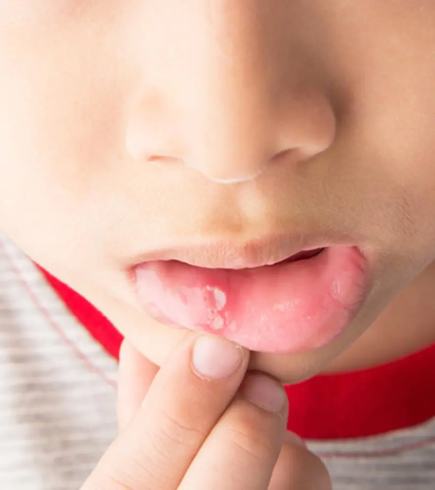 Canker Sores: Causes And How To Get Rid Of