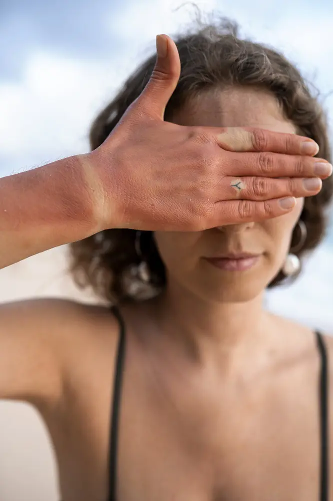 15 Home Remedies For Sunburn For Instant Relief